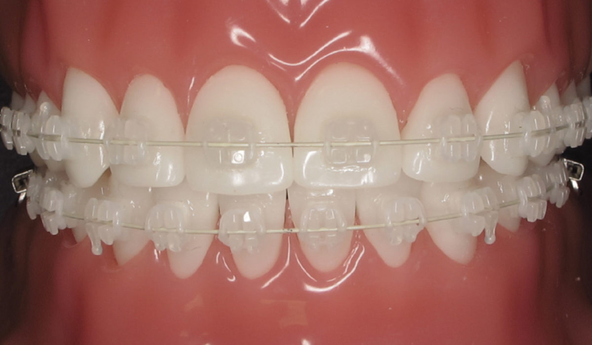 CERAMIC BRACES